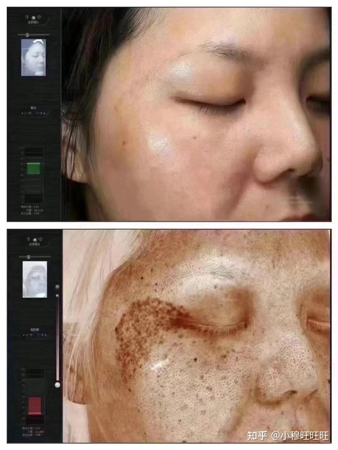 激光祛斑，選擇醫(yī)院還是美容院？全面解讀助您做出明智決策，激光祛斑，如何選擇醫(yī)院與美容院？全面解讀為您指明決策方向