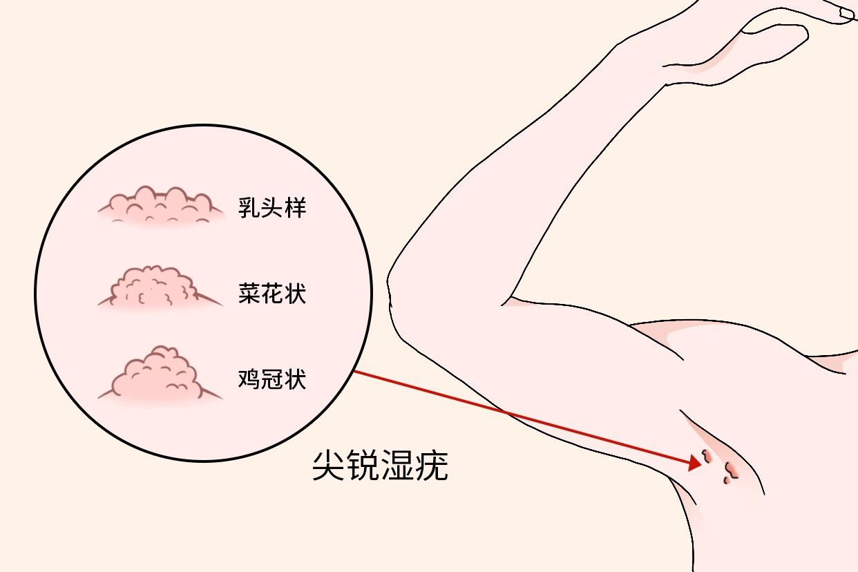 尖銳濕疣圖片，了解、識別與防治，尖銳濕疣圖片詳解，識別、防治全攻略