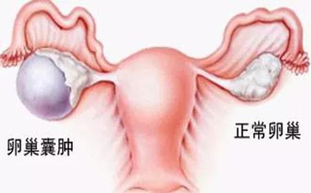 卵巢囊腫的十個(gè)征兆，卵巢囊腫的十個(gè)征兆解析
