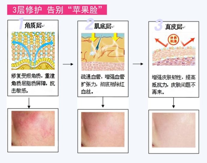 治療紅血絲的最佳方法，治療紅血絲的最佳方法簡述