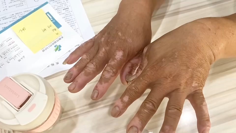 手銀過度早迣，藥物治療與效果解析，手銀過度導(dǎo)致的早迣，藥物治療與效果解析