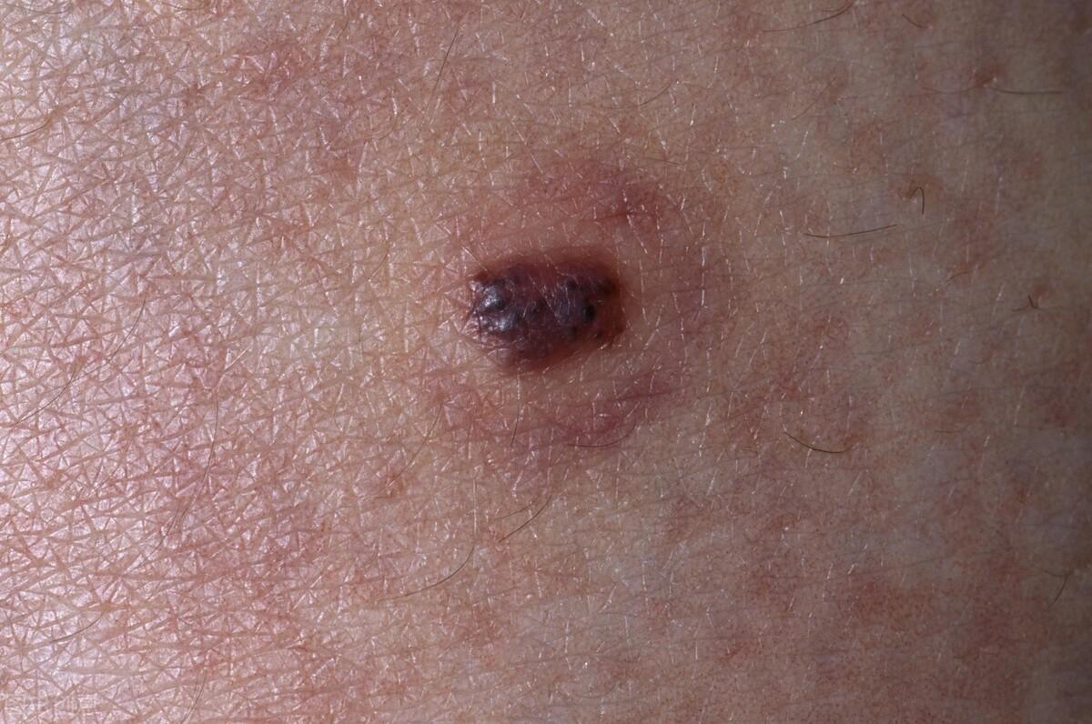 血痣和紅痣的區(qū)別圖片，深入了解兩種皮膚狀況，血痣與紅痣的區(qū)別詳解，專(zhuān)業(yè)圖片解析，深入了解兩種皮膚狀況特征