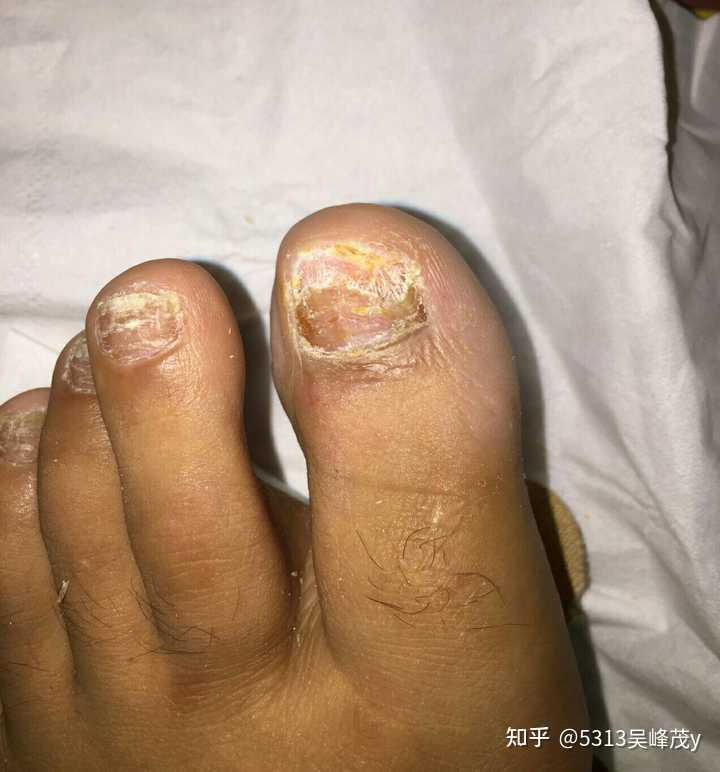 如何判斷自己是否得了灰指甲？，如何判斷自己是否得了灰指甲？詳細指南與解析。