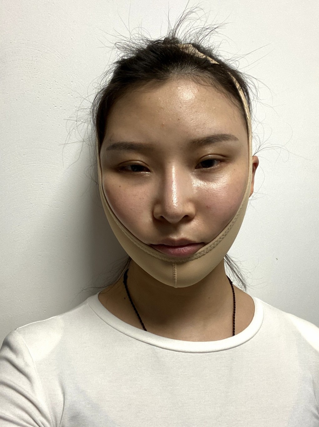 面部吸脂十天后的變化，圖片與經(jīng)驗分享，面部吸脂十天，變化、圖片與經(jīng)驗分享