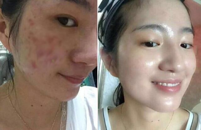 痘印多久會自己消失？全面解析痘印消失時間與影響因素，痘印消失時間全面解析，影響因素與消失時長探討