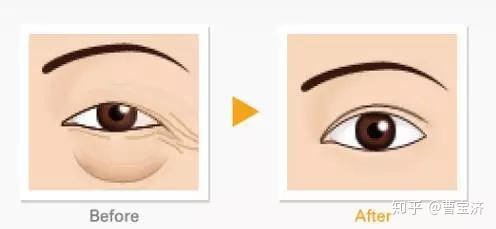 尋找最佳的眼袋治療醫(yī)院，專業(yè)解析與推薦，專業(yè)解析眼袋治療醫(yī)院推薦，助您尋找最佳治療機構(gòu)