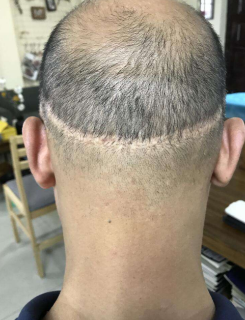 植發(fā)效果的持久性，能否長期維持與多種因素相關(guān)，植發(fā)效果的持久性與多種因素關(guān)聯(lián)，長期維持探討