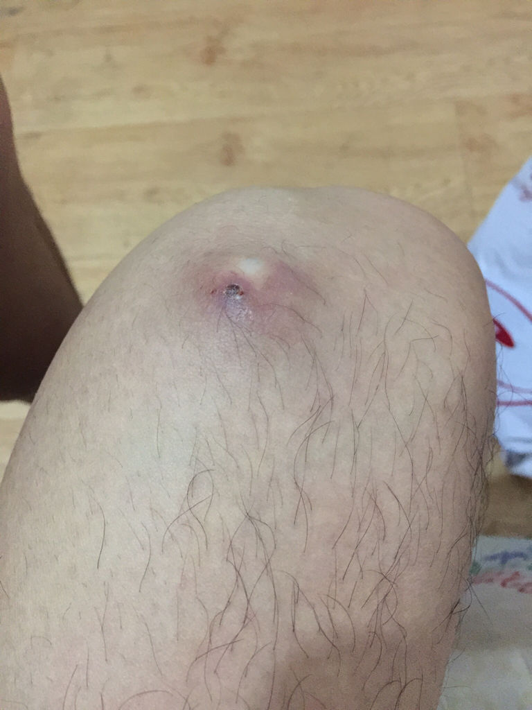 痘痘長(zhǎng)不出來，肉里硬硬的，原因解析與應(yīng)對(duì)建議，痘痘無法冒出表面，內(nèi)部硬結(jié)成因解析及應(yīng)對(duì)之策