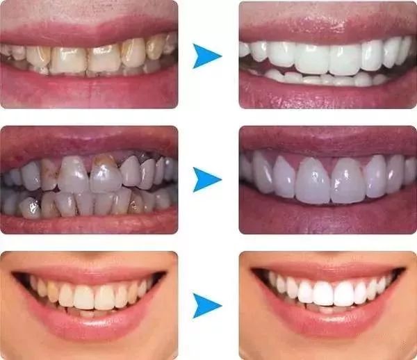 牙齒洗白要多少錢？全面解析牙齒美白費(fèi)用因素，牙齒美白費(fèi)用全解析，牙齒洗白需要多少錢？