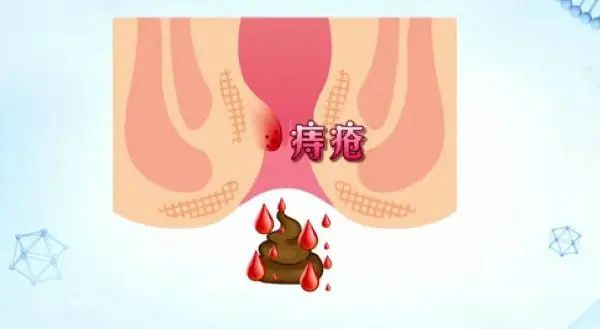 大便出血，痔瘡還是肛裂？一篇文章帶你了解，大便出血，痔瘡還是肛裂？一篇文章全面解析