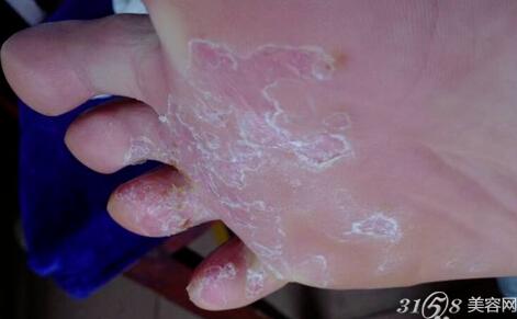 腳脫皮怎么辦？藥物治療推薦與護理建議，腳脫皮解決方法，藥物治療推薦及護理建議