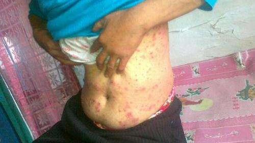 男生下面流膿，原因、應對措施與健康提醒，男性私處流膿，原因、應對與健康警示