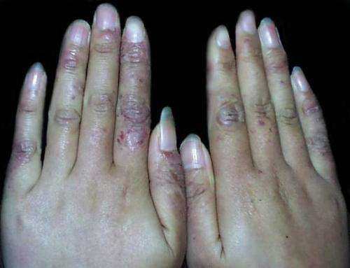 根治凍瘡，預(yù)防復(fù)發(fā)，全面解析凍瘡的治療方法，根治凍瘡，預(yù)防復(fù)發(fā)，全面解析凍瘡治療策略