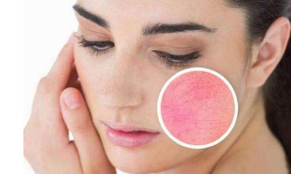 如何有效去除紅血絲，最佳方法與實用建議，紅血絲去除攻略，最佳方法與實用建議