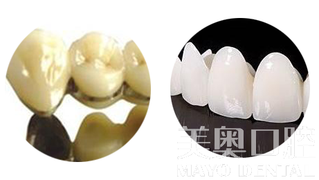 烤瓷牙和全瓷牙的利與弊，深度解析，深度解析，烤瓷牙與全瓷牙的優(yōu)缺點(diǎn)對(duì)比