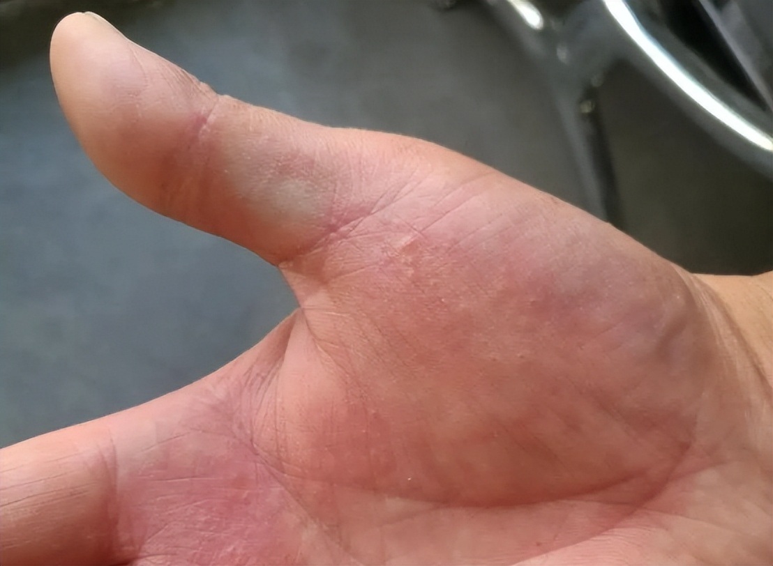 手上起小水泡圖片，原因、治療與預(yù)防，手上起小水泡，圖片詳解、成因、治療與預(yù)防方法